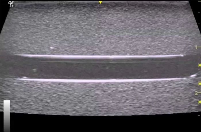 Hm2.0 Re-Moldable 2 Vessel Ultrasound Training Model - Image 9