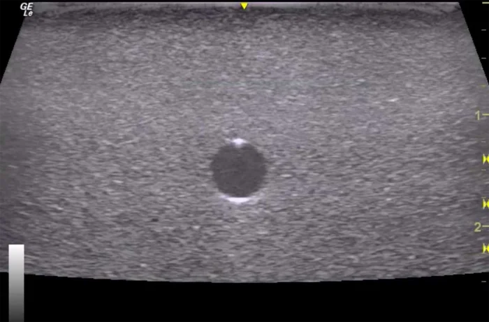 Hm2.0 Re-Moldable 2 Vessel Ultrasound Training Model - Image 13