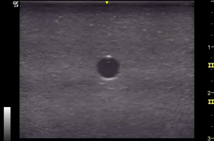 Hm2.0 Re-Moldable 2 Vessel Ultrasound Training Model - Image 10