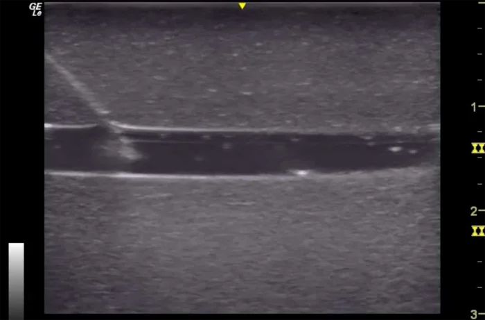 Hm2.0 Re-Moldable 2 Vessel Ultrasound Training Model - Image 6