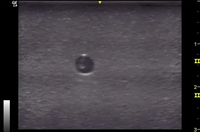 Hm2.0 Re-Moldable 2 Vessel Ultrasound Training Model - Image 11